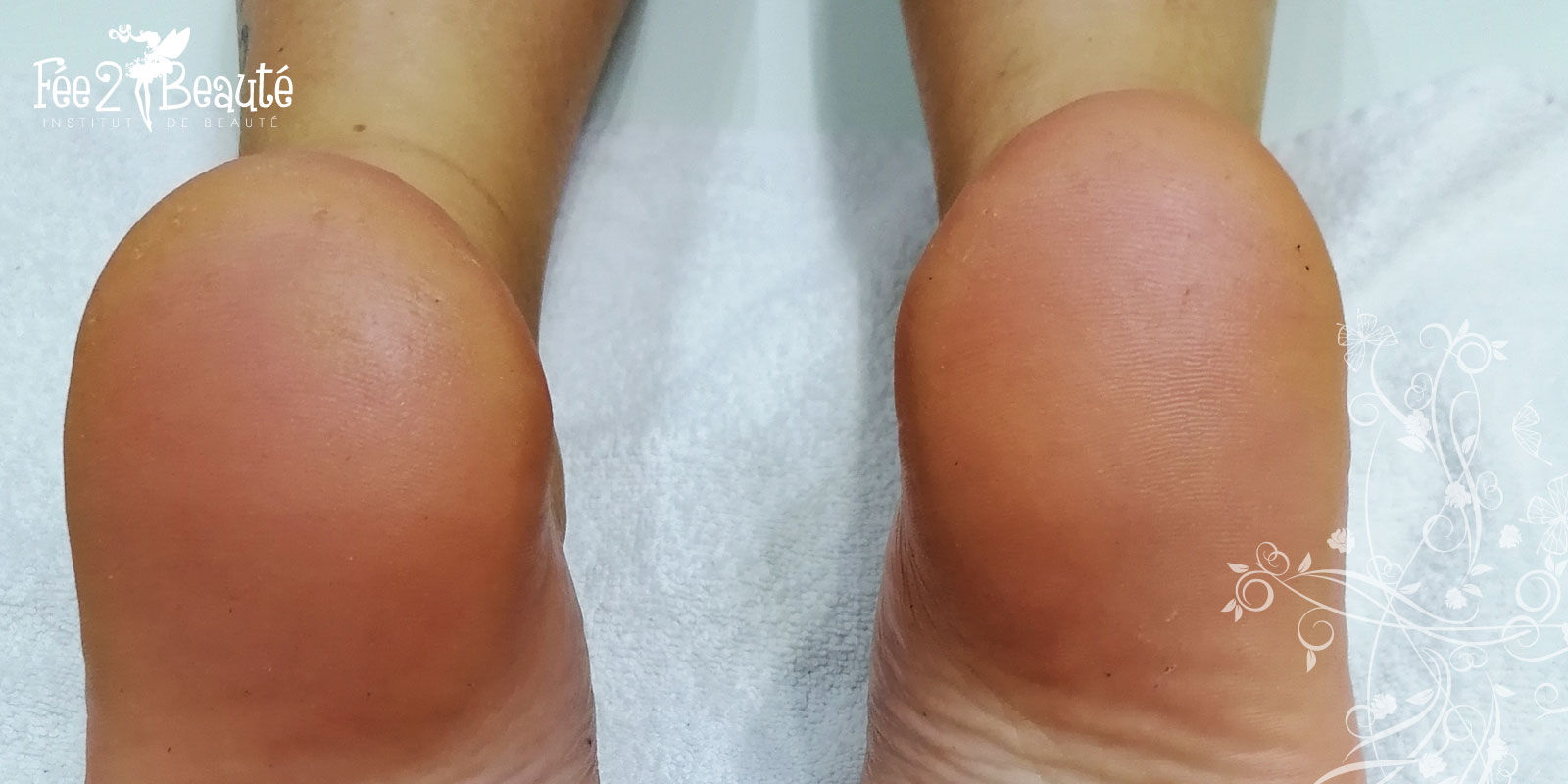 Après le soin anti-callosités Yumi Feet